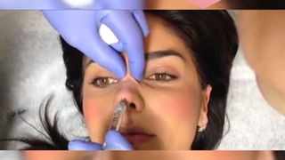 از بین بردن قوز بینی با تزریق ژل و چربی ترمیم زیبایی دندان