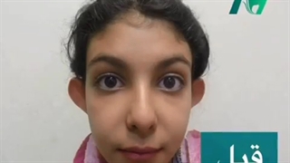 نمونه جراحی زیبایی اتوپلاستی (جراحی گوش)