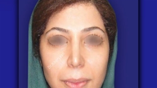 رینوپلاستی | دکتر خوروش