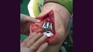 عمل جراحی تعویض مفصل زانو