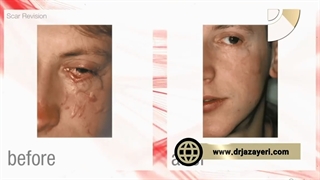 کاربردهای لیزر co2 فرکشنال