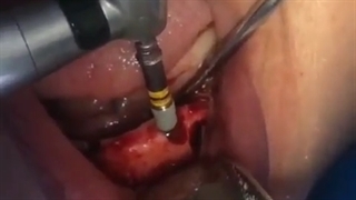 اکسپوژر ( نمایان کردن) دندانهای نیش نهفته