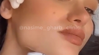 از بین بردن غبغب با دستگاه هایفو