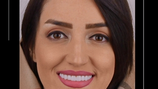 اصلاح طرح لبخند
