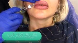 فیلم تزریق فیلر لب