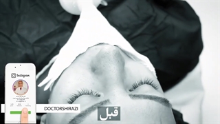 فیلم کامل جراحی بینی