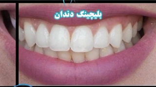 بلیچینگ دندان ها توسط دکتر جنانی