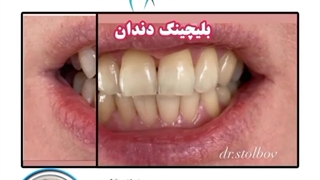 بلیچینگ دندان