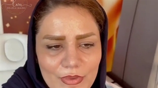 ۳ماه بعد از جراحی همزمان اندوسکوپیک سینوسها و زیبایی بینی