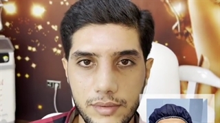 سه هفته بعد از جراحی بینی گوشتی و کج بینی مردانه