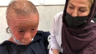 فیلم درمان بیماری ایکتیوز طاهره عزیز توسط دکتر الهه لطفی برداشتن خال گوشتی