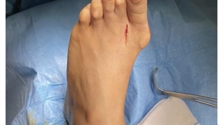 فیلم واقعی از عمل جراحی انحراف شست پا در اتاق عمل