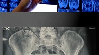 استوتومی گانز