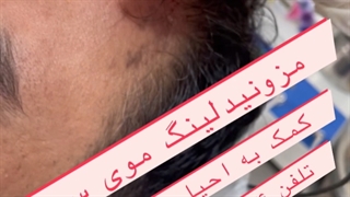 مزونیدلینگ موی سر