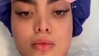 لیفت ابرو بدون جراحی کربوکسی تراپی