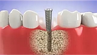 ایمپلنت دندان ساخته شده از تیتانیوم