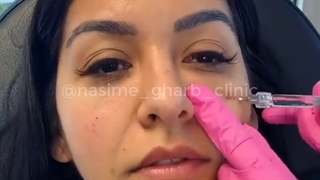 تزریق ژل گونه با برند بلوترو
