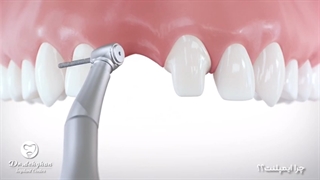 چرا ایمپلنت؟