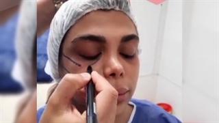 تزریق چربی صورت پریودنتیکس