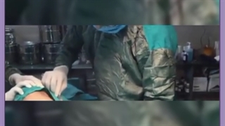 همه چیز در خصوص تزریق چربی اس وی اف ژل به باسن ارتودنسی