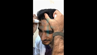 از بین بردن جای زخم با دستگاه پلاسما الکتروسرجیکال