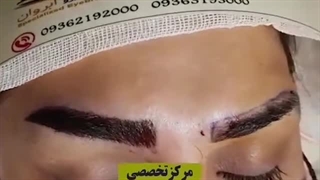 نتیجه فوق العاده کاشت ابرو| کلینیک ابروان