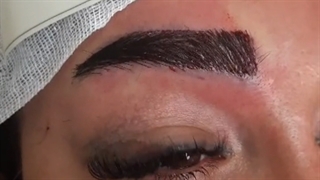 فیلم جراحی کاشت ابرو بدون درد| کلینیک ابروان