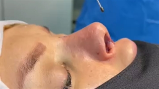 جراحی بینی یعنی این