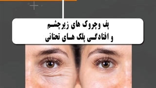 نکاتی درباره بلفاروپلاستی که باید بدانید