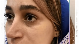رفع گودی و سیاهی زیر چشم