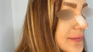 تزریق ژل لب و اصلاح فرورفتگی چانه