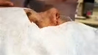 نتیجه ی عمل بینی بلافاصله بعد از عمل