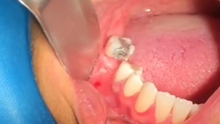 ایمپلنت دندان تزریق ژل