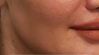 کات گونه با فیلر هیالورونیک اسید توسط دکتر حمید ارونقی