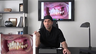 کیس پیچیده ایمپلنت