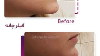 اصلاح فرم چانه با تزریق فیلر توسط دکتر حمید ارونقی