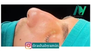 فیلم واقعی عمل بینی در اتاق عمل