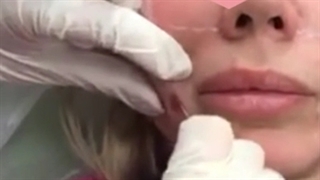 چگونه صورت لاغر را توپر کنیم؟ اکستنشن تاج دندان