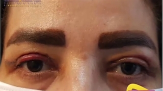 4 روز پس از جراحی پلک