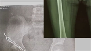 دررفتگی مادرزادی مفصل لگن DDH