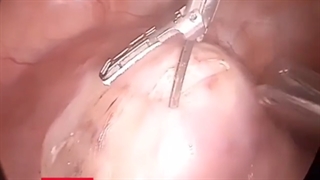 فیلم بدون سانسور از جراحی خارج کردن میوم بزرگ با حفظ رحم