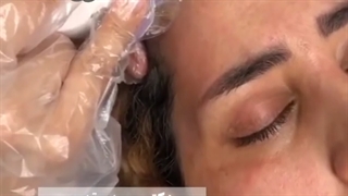 فیلم واقعی لیزر آر اف فرکشنال برای جوانسازی پوست صورت