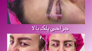 بلفاروپلاستی