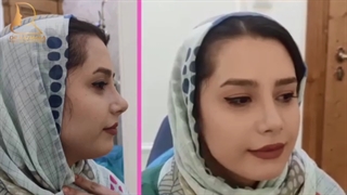 عمل بینی فانتزی استخوانی