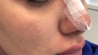فیلم واقعی تزریق چربی و فرم دهی صورت
