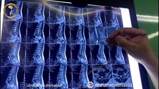 جراحی انحراف ستون فقرات