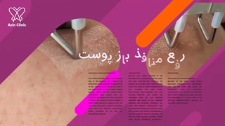 رفع منافذ باز، درمان جای جوش و لک های صورت جراحی گوش