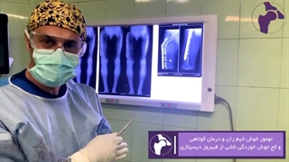 تومور خوش خیم ران و درمان کوتاهی