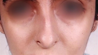 جراحی زیبایی بینی