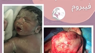 فیلم واقعی و بدون سانسور از اتاق عمل زایمان سزارین همراه خارج کردن فیبروم